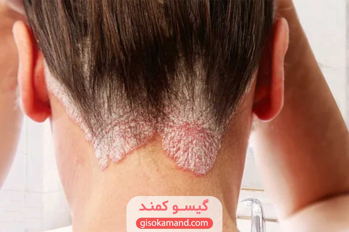 التهاب پوست با رنگ مو