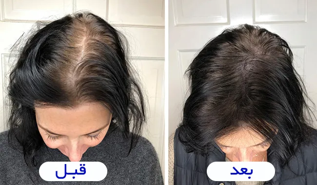 کاشت مو برای خانمها امکان پذیر است