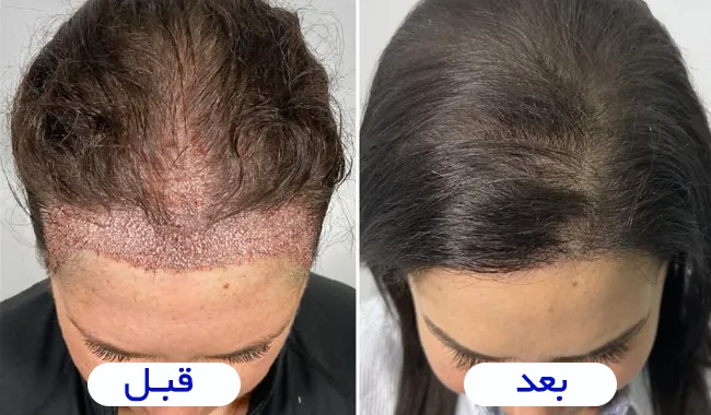 روش های کاشت مو در زنان