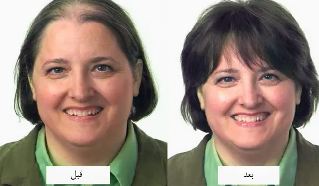 مراحل کاشت مو در خانم ها