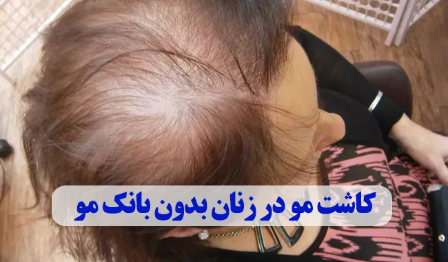 کاشت مو در زنان بدون بانک مو